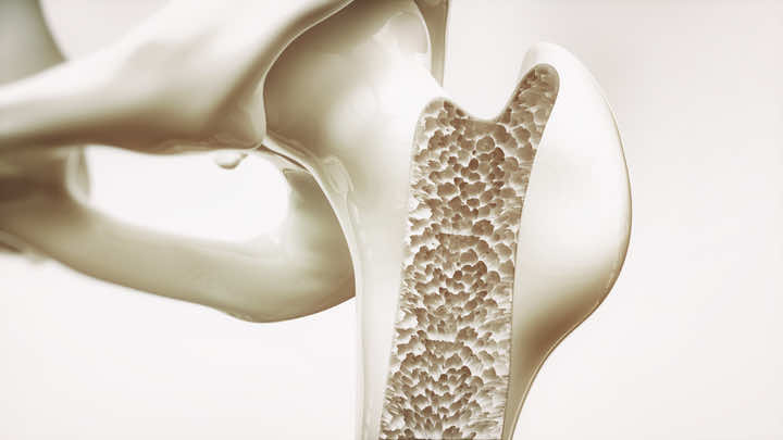 Cross section of bone with Osteoporosis